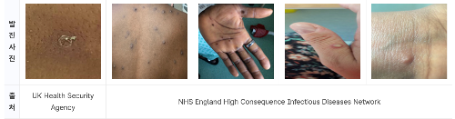 엠폭스 발진사진