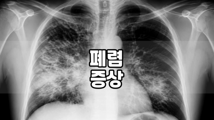 폐렴 증상