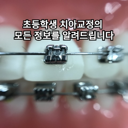 초등학생 치아교정