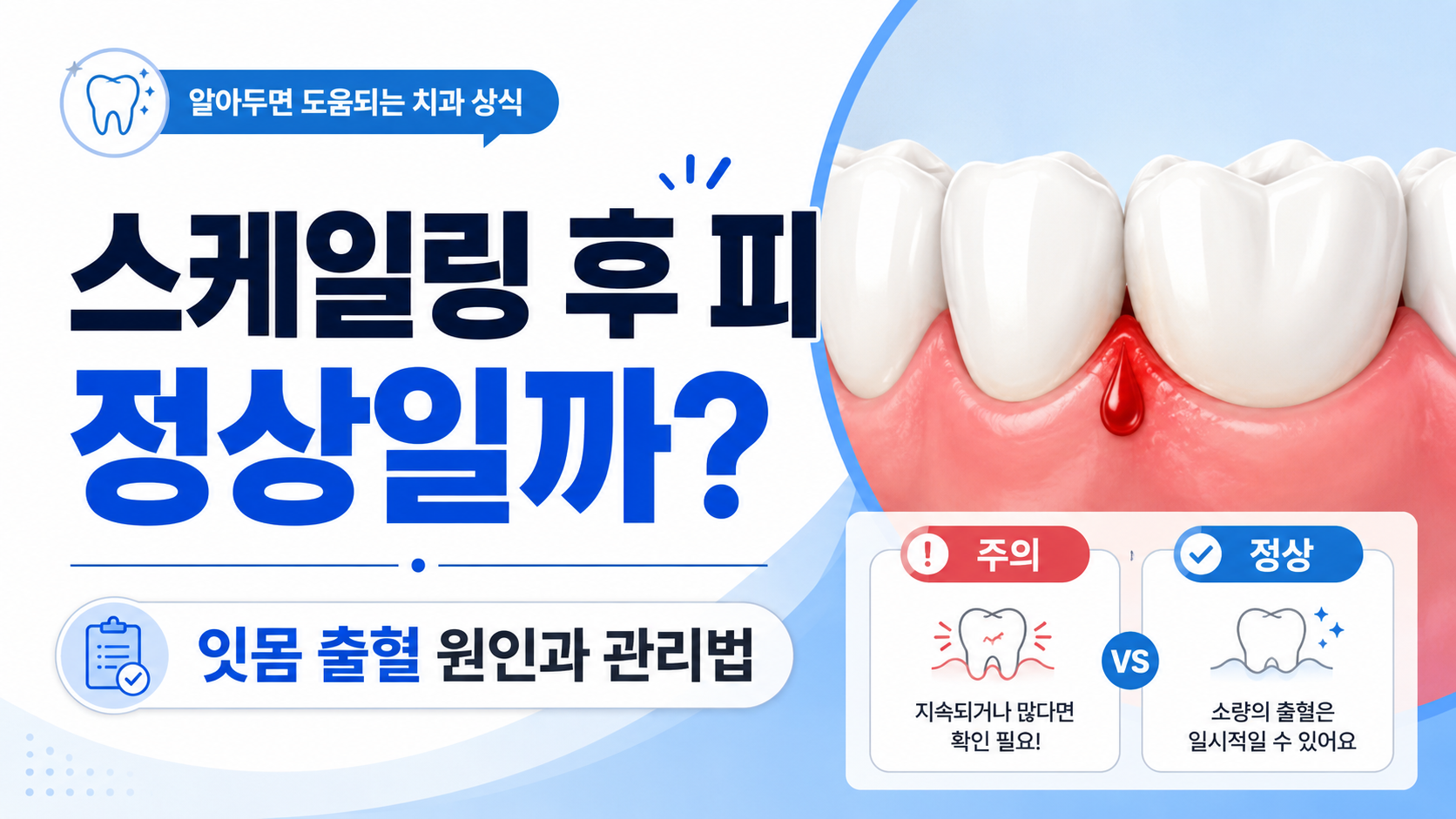 스케일링 후 피 나는 이유와 잇몸 출혈 원인
