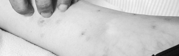 빈대 물린자국: 대응 중요성