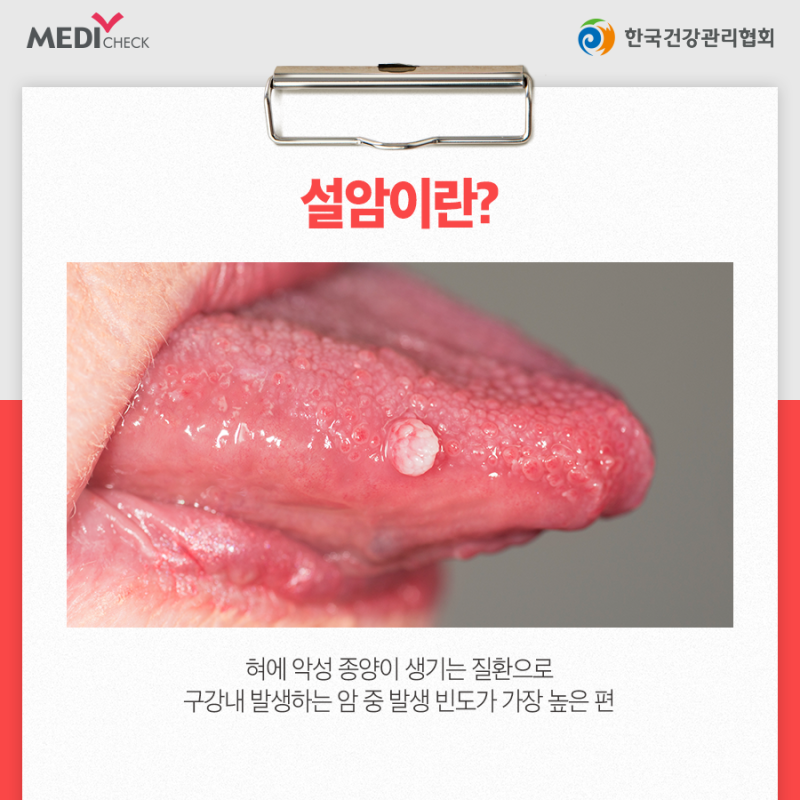 설암