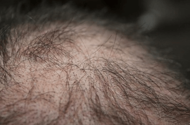 모발이식 3000모 비용