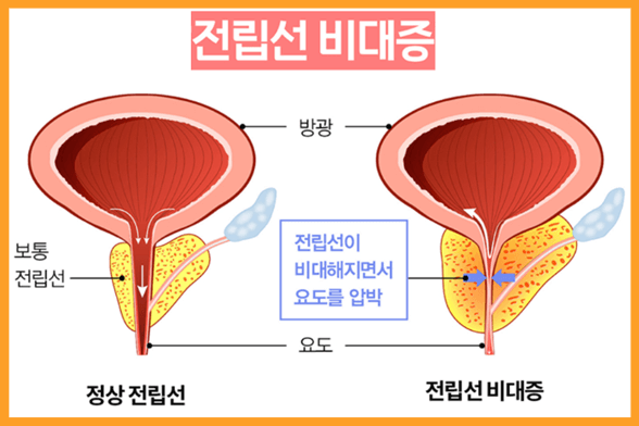 소변이-자주-마려운-증상