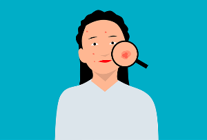 노스카나 겔 연고 효과&amp;#44; 가격&amp;#44; 사용법:여드름 흉터 치료제 추천합니다.