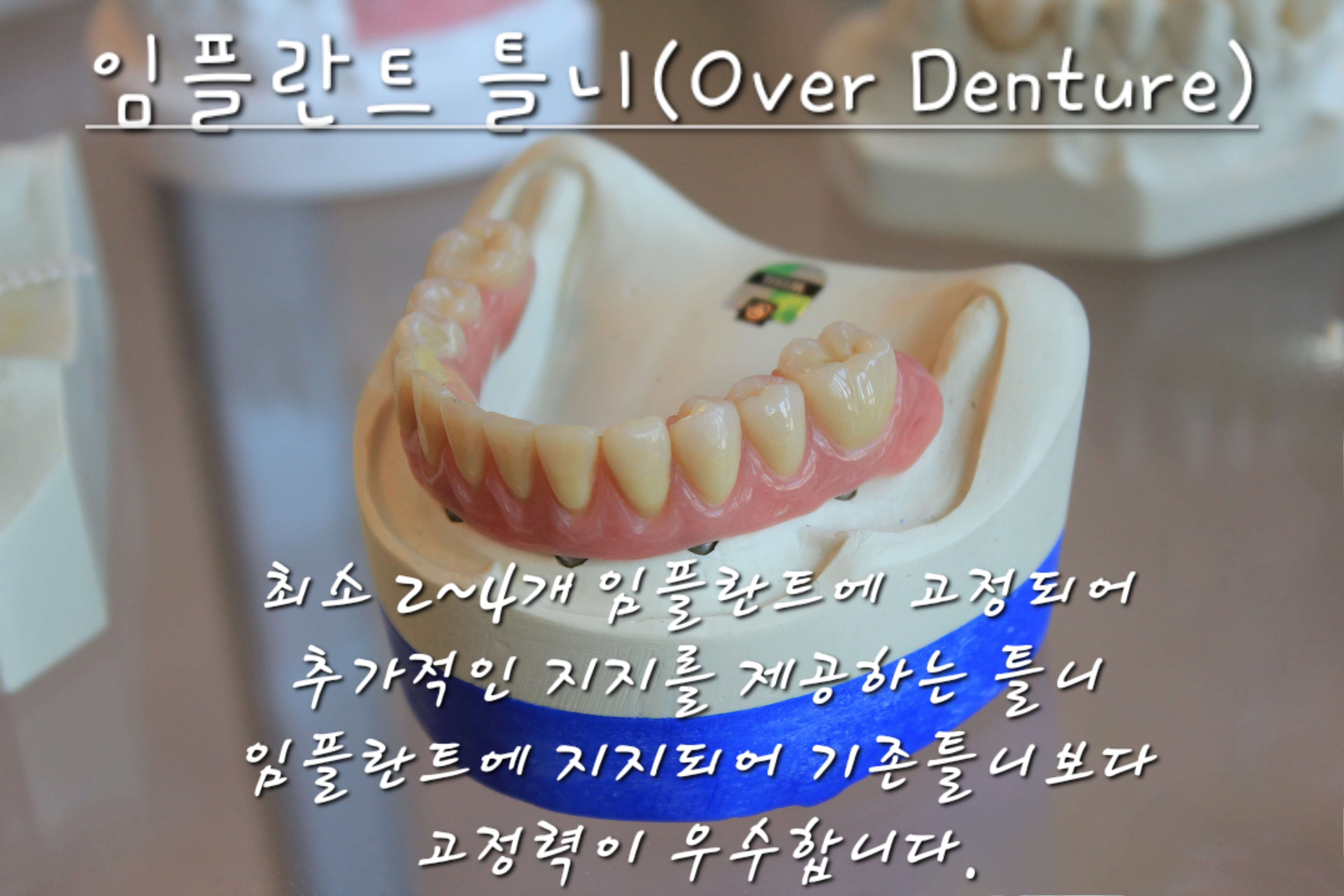 임플란트 틀니 사진