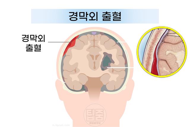 뇌혈관 터짐 위치 뇌출혈 종류 경막외출혈