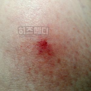 쯔쯔가무시 증상