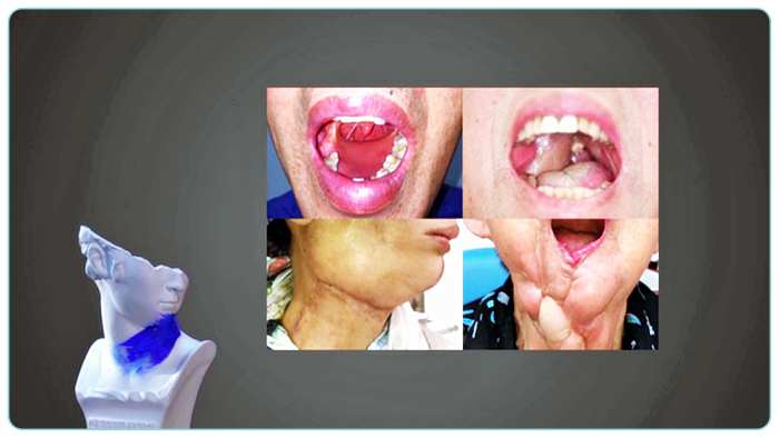 ebs-명의-구강암-사례
