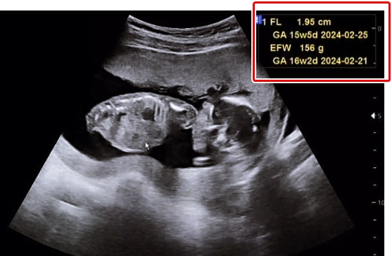 초음파사진16주