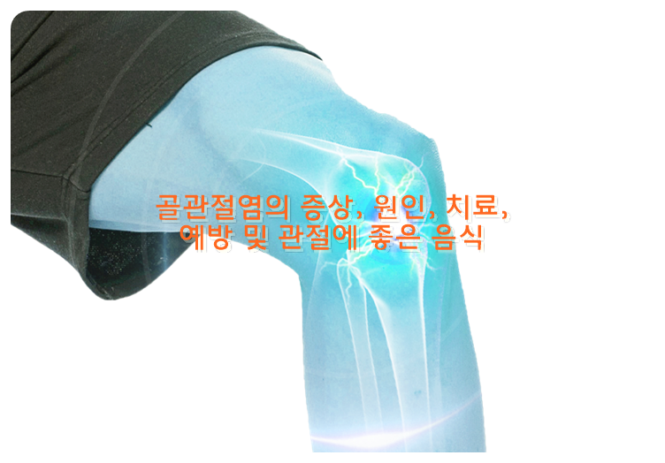 골관절염의 증상, 원인, 치료, 예방 및 관절에 좋은 음식