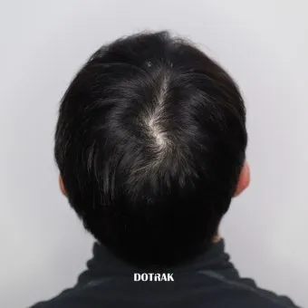 정수리가 아픈 이유와 완화하는 방법_25