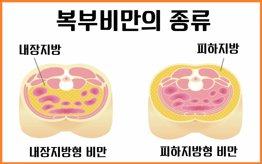 복부비만 종류