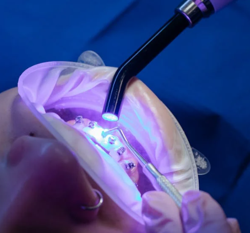 강원 고성군 치과 임플란트 가격 종류 비교