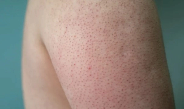 모공각화증 치료 방법 7가지