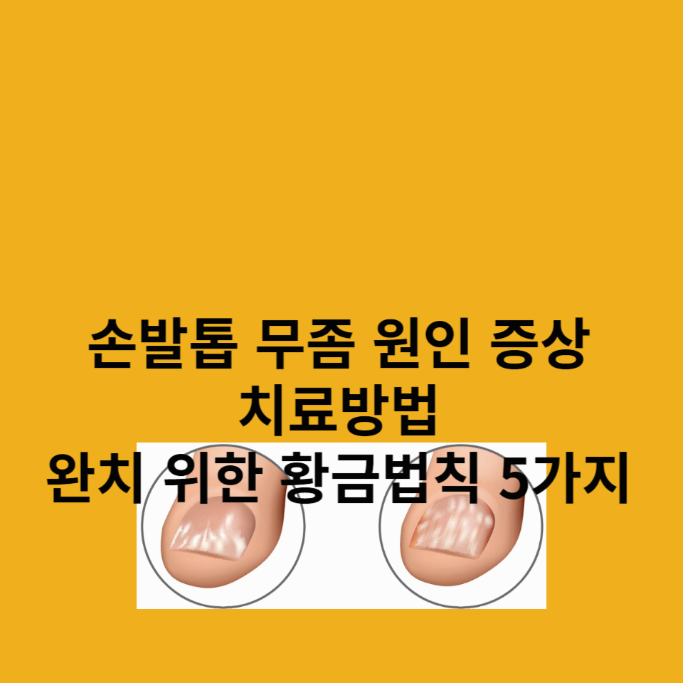 손발톱-무좀-원인-증상-치료