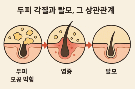 두피 각질과 탈모, 그 상관관계