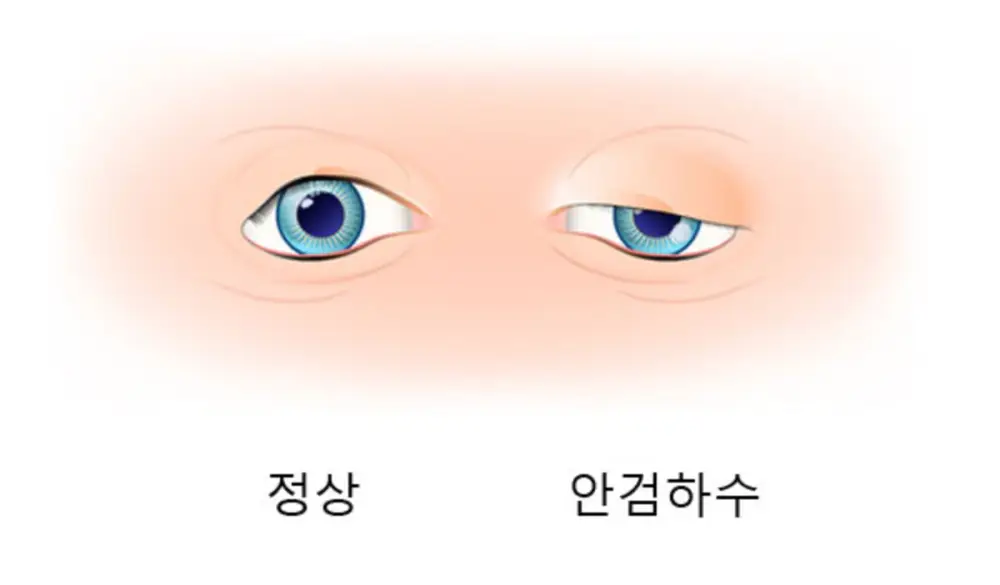 안검하수와-정상-눈비교
