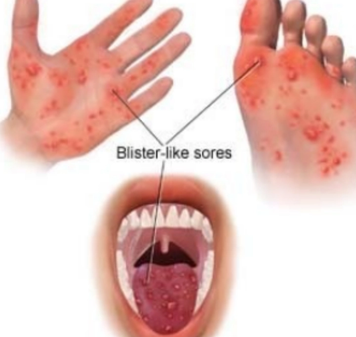 수족구-증상-사진