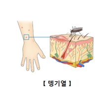 뎅기열