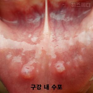 수족구 증상