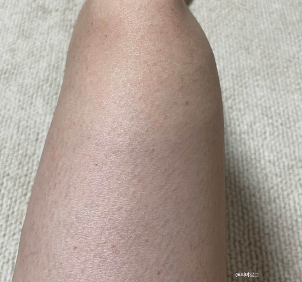 모공각화증-치료-로션-연고-가려움-사용전