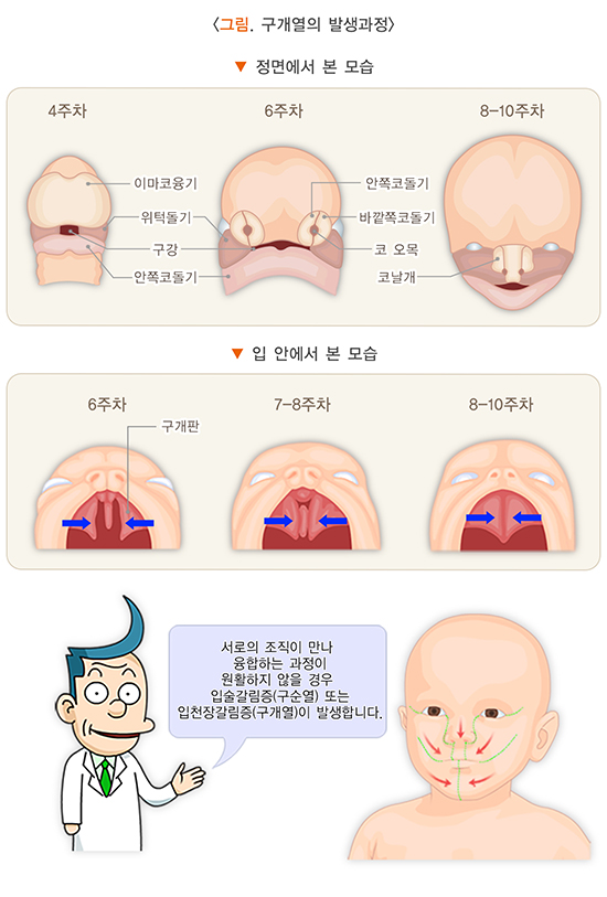 구개열의 발생과정 이미지