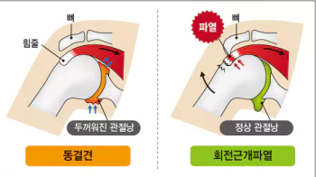 오십견-회전근개-파열-차이4