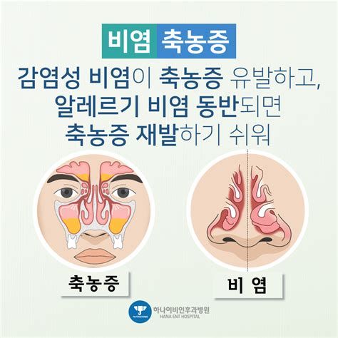 축농증