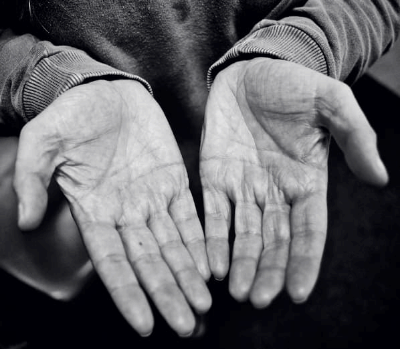 손가락 관절염 증상과 치료법