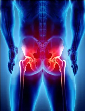 사타구니 통증 원인