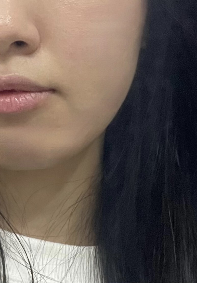 온다 리프팅 후기