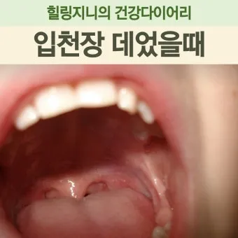 입천장 헐었을 때 면역력 저하 관련 증상과 영양 관리법_5