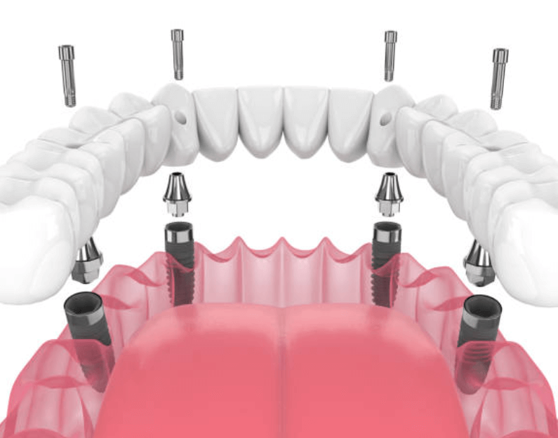 임플란트 틀니