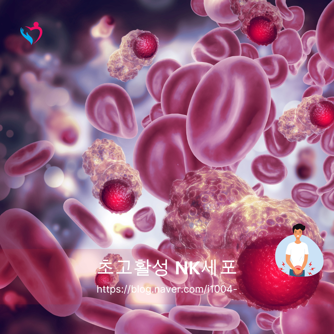 NK세포 암 예방 일본 치료에 대하여