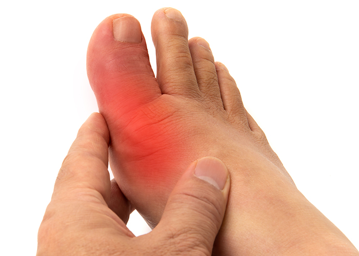 엄지발가락 관절부분이 통풍으로 인한 발적이 있는 이미지