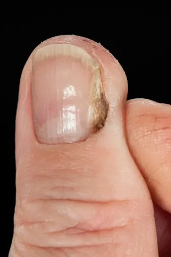 손톱이 갈라지는 이유 원인 증상 대처법_12