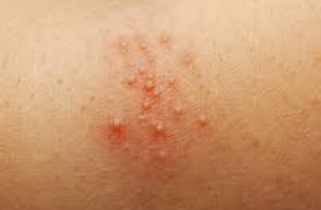 땀띠 대상포진 구별법