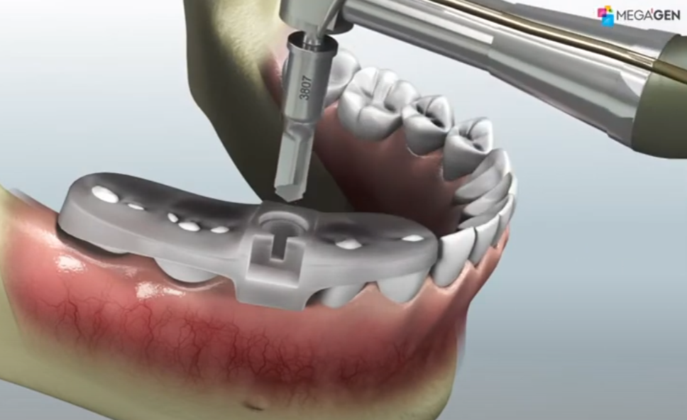 메가젠 r2임플란트 스텐트