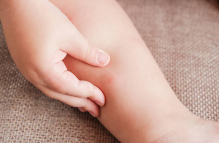 수족구 증상, 격리기간, 치료 총정리 (2024ver)