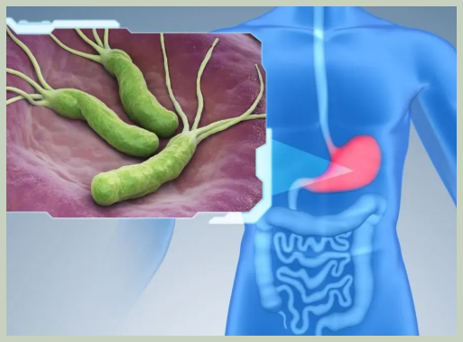 헬리코박터균 감염 증상