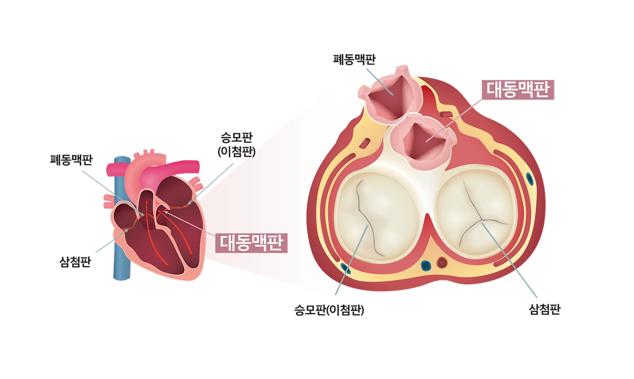 대동맥판막 협착증