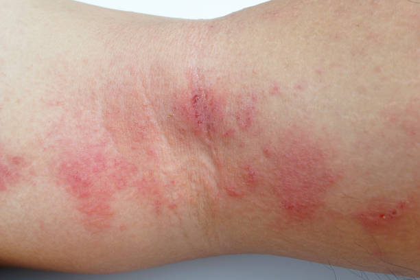 신체 부위별 대상포진 발병 상황