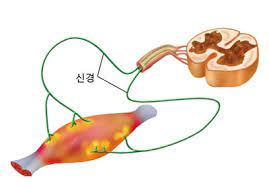 역류성 식도염
