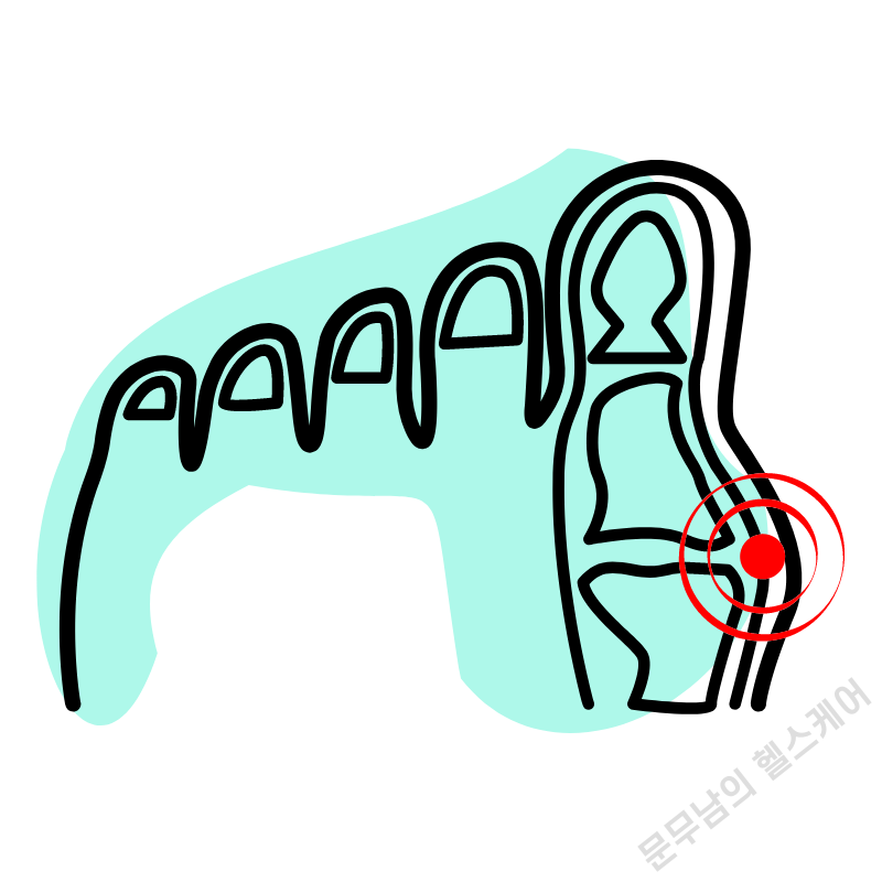 엄지발가락 옆 통증