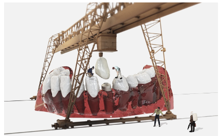 2023년 임플란트 가격