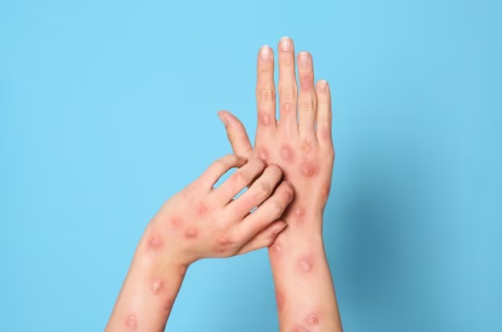 엠폭스-초기증상