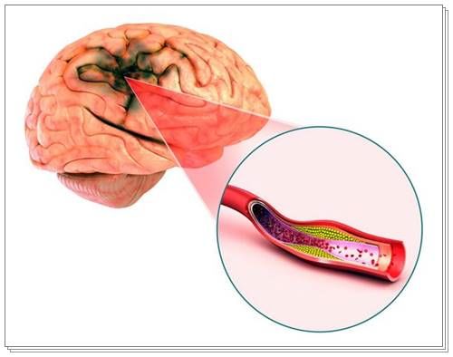 뇌혈관질환 전조증상