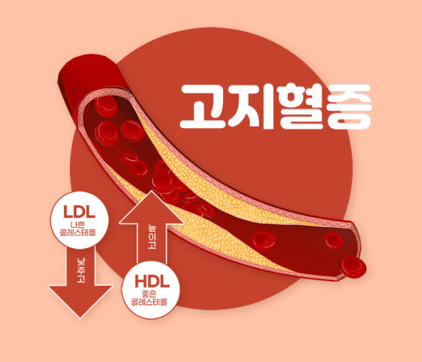 고지혈증과 갱년기의 관계|호르몬 변화가 혈관 건강에 미치는 영향 관련 사진