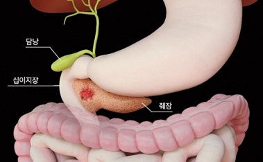 췌장암명의